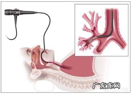 治疗哮喘该如何合理用药?