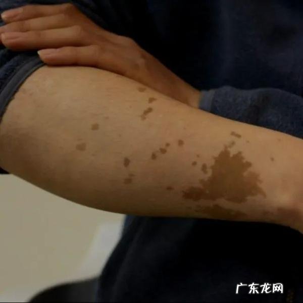 20多年胎记缠身 年轻小伙终获祛记曙光 祛胎记医院