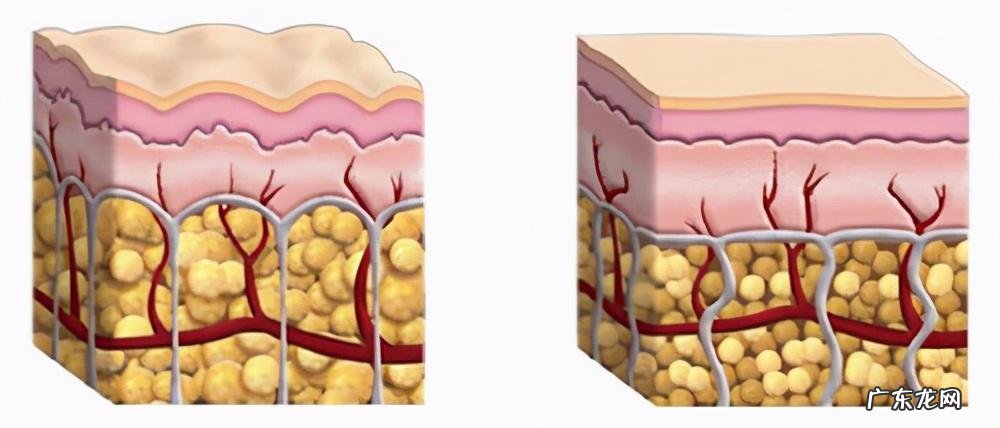 吸脂怎么吸 吸脂减肥效果怎么样