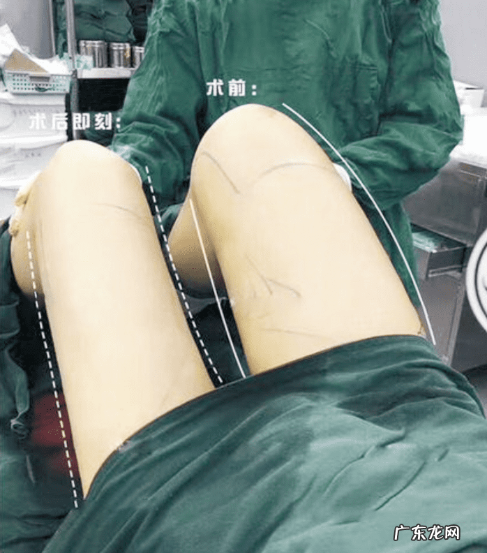 吸脂怎么吸 吸脂减肥效果怎么样