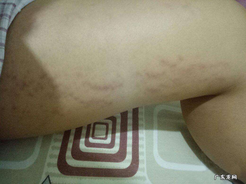 妊娠纹怎么预防 预防妊娠纹用什么好