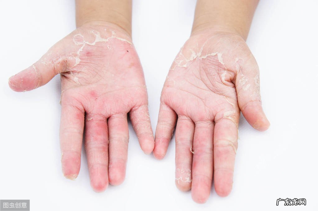 神经性皮炎会传染给别人吗 神经性皮炎传染吗?