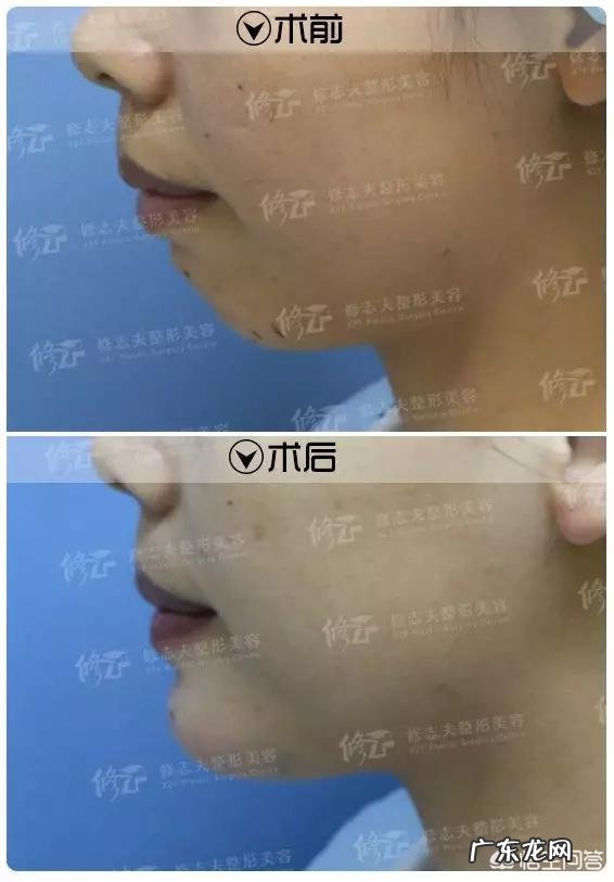 下巴怎么变长?