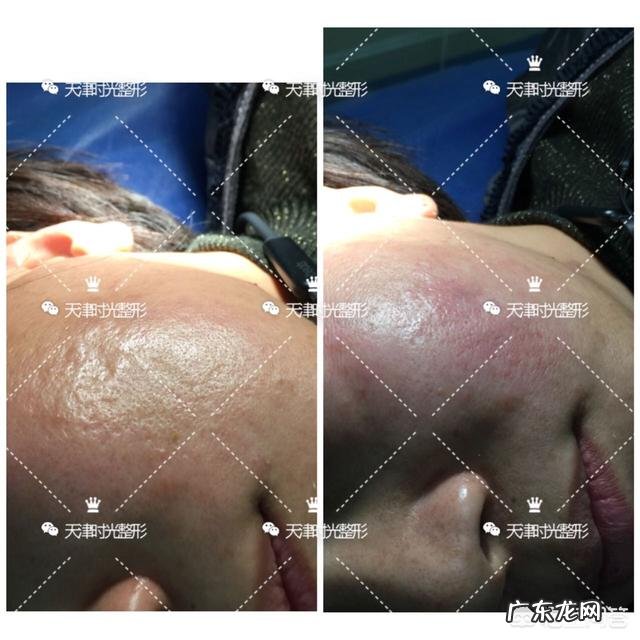 痘坑能用玻尿酸修复吗?