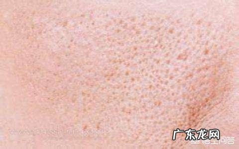 毛孔粗大该如何有效的改善?