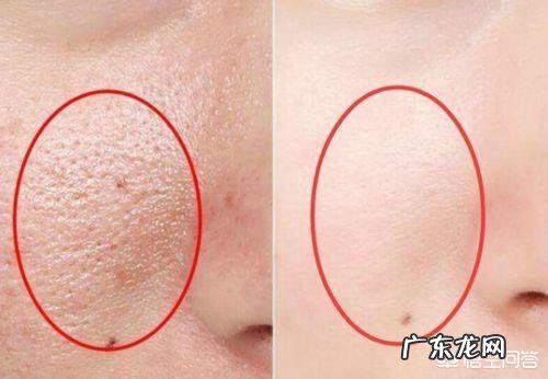 毛孔粗大该如何有效的改善？