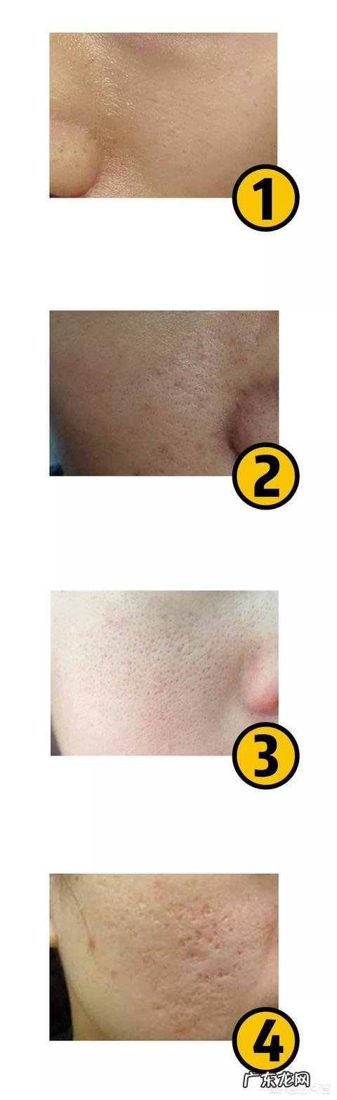 毛孔粗大该如何有效的改善?
