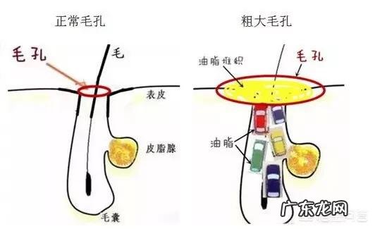 毛孔粗大该如何有效的改善?