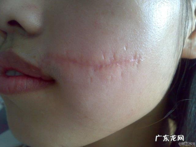 怎么淡化做手术留下的疤?