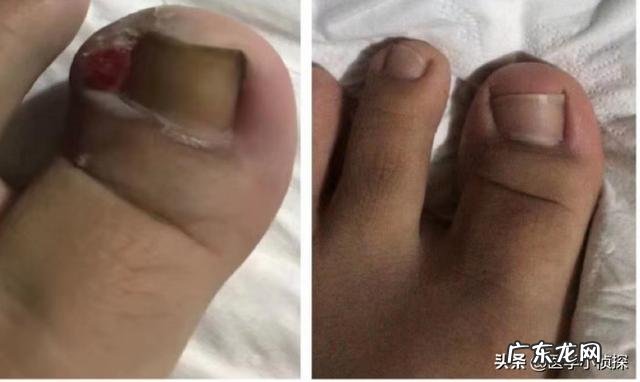 指甲上出现凹横杠是什么病?