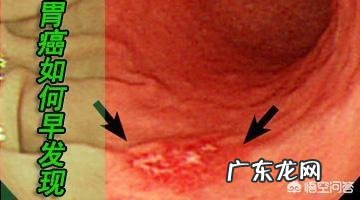 胃癌早期的治愈率大概多少?