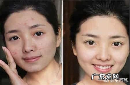 长痘对颜值的影响有多大?