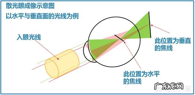小孩子的眼睛散光能不能治愈？