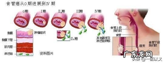 食道癌转肝癌晚期还能活多久？