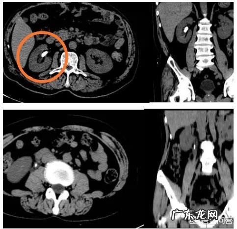 怎么预防肾结石?