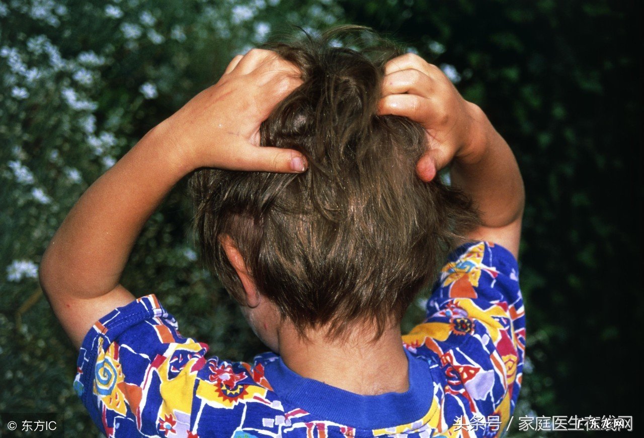 头上的虱子长什么样子 头上长虱子怎么办