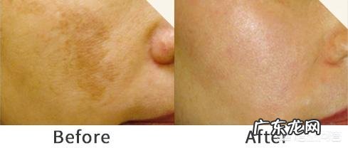 哪种方法祛斑比较好,不反弹无副作用的?