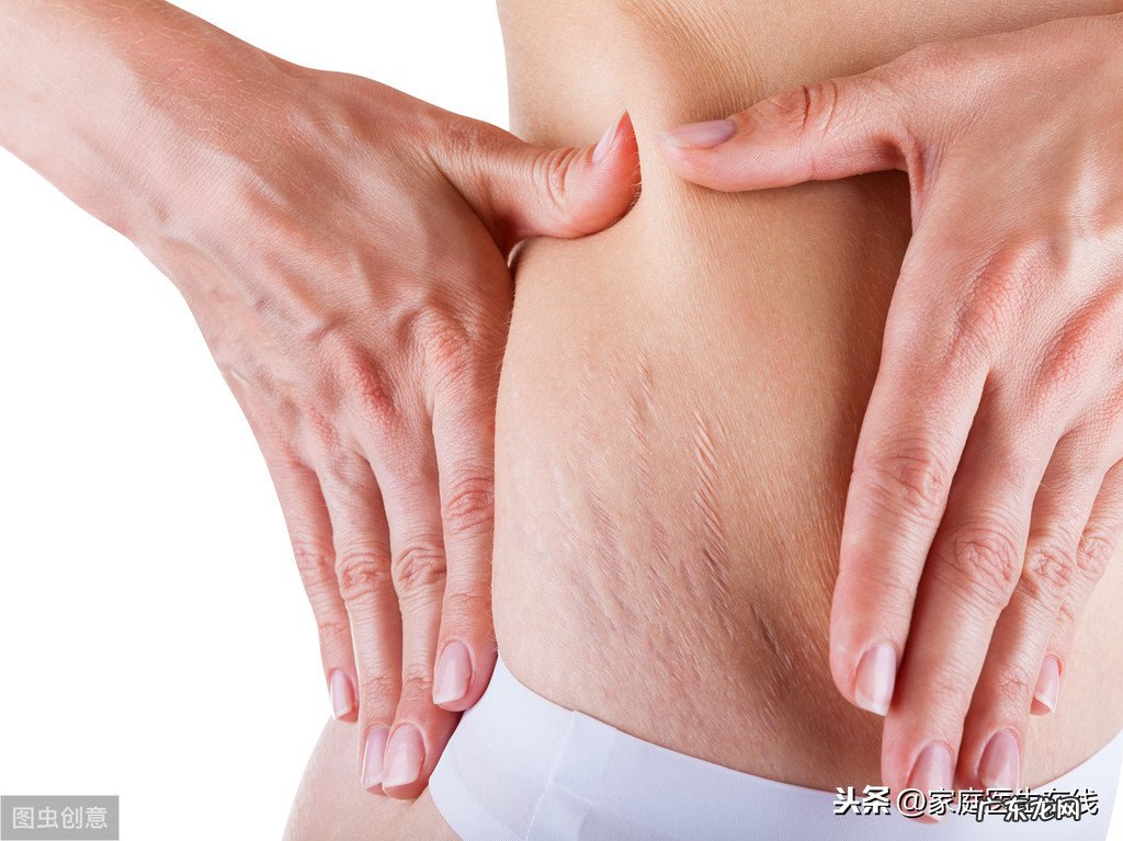 妊娠纹可以割除吗 肚子妊娠纹能去掉吗