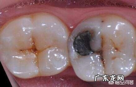 怎样预防蛀牙最有效?