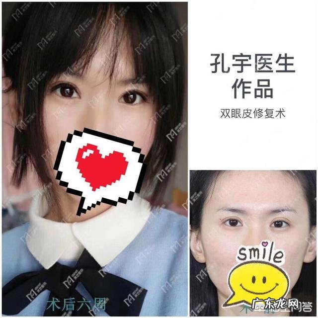 眼睛一大一小怎么办?