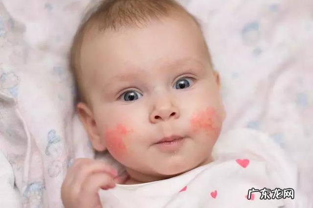 什么人容易过敏?怎样预防和治疗?