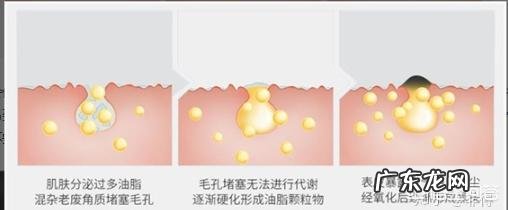 黑头贴好还是吸黑头仪器好？