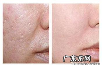 去凹凸痘印的方法有什么？