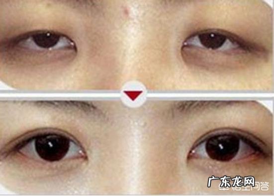 上睑下垂如果不做提肌只割双眼皮会是什么样的?