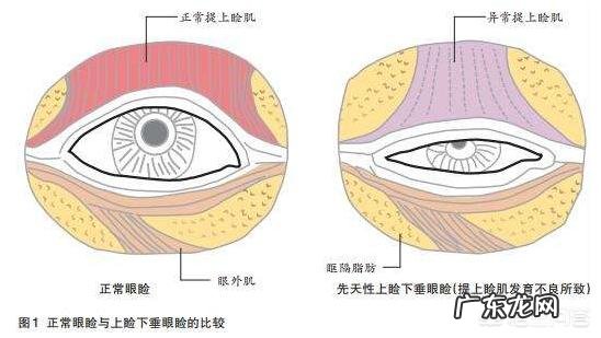 上睑下垂如果不做提肌只割双眼皮会是什么样的?