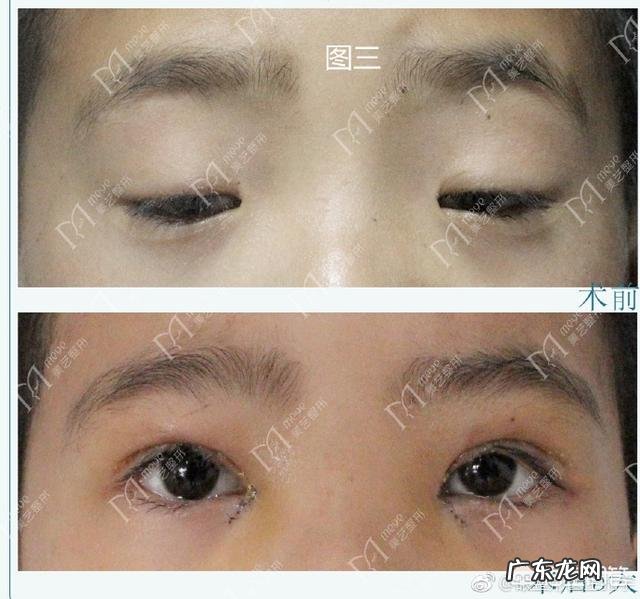 上睑下垂如果不做提肌只割双眼皮会是什么样的?