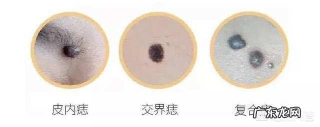 身上哪些部位的黑痣需要警惕,可能是癌症的信号?