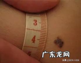 身上哪些部位的黑痣需要警惕,可能是癌症的信号?