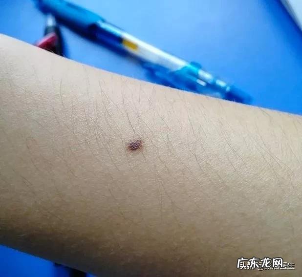 身上哪些部位的黑痣需要警惕,可能是癌症的信号?