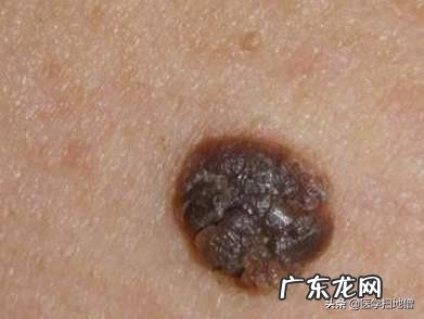 身上哪些部位的黑痣需要警惕，可能是癌症的信号？