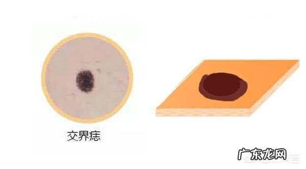 身上哪些部位的黑痣需要警惕,可能是癌症的信号?