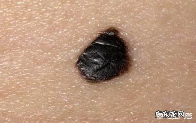身上哪些部位的黑痣需要警惕,可能是癌症的信号?