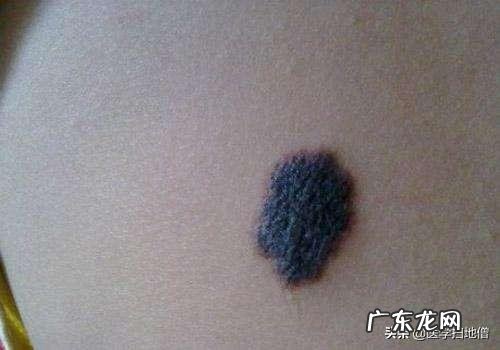 身上哪些部位的黑痣需要警惕，可能是癌症的信号？