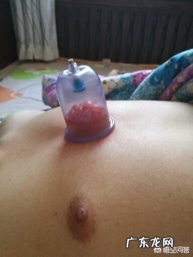 拔罐真的能祛湿吗?