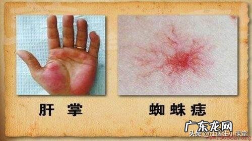 肝不好的人，会有哪些症状？