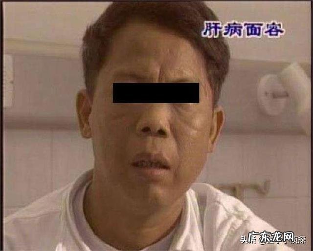 肝不好的人,会有哪些症状?