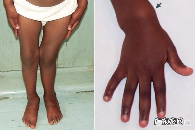 先天性佝偻病的宝宝有什么症状?