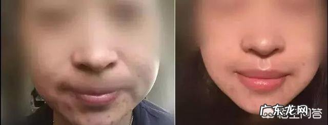 你是怎么处理好自己的青春痘或痘印的？