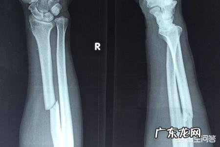 哪些食物有利于骨折病人康复?