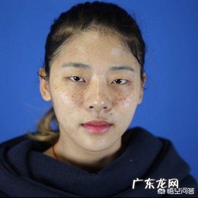 什么是雀斑?怎么去除?