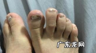 女生得了灰指甲是不是很尴尬 女孩子得了灰指甲很丢人吗