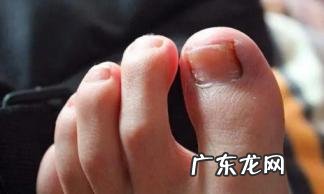 灰指甲最开始的症状会发脓吗 我的灰指甲怎么自愈了