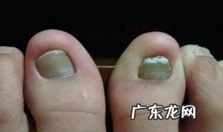 得了灰指甲要不要紧 灰指甲脱落代表什么