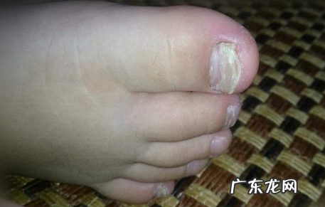 灰指甲需要每天去刮吗 灰指甲根本就治不好吗