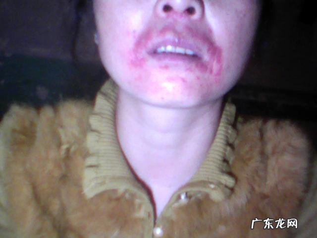 口周皮炎图片及症状，在嘴巴周围长丘疹脓疱如何预防
