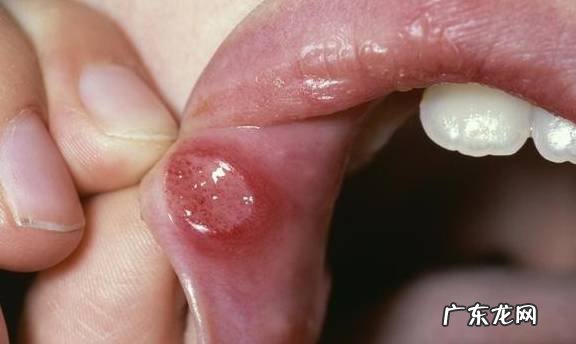 口周皮炎图片及症状，在嘴巴周围长丘疹脓疱如何预防